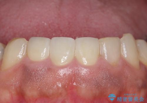 オールセラミッククラウン ブリッジによる欠損歯の補綴の治療後