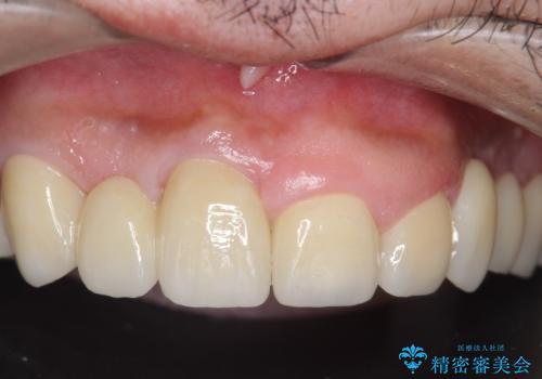 オールセラミッククラウン ブリッジによる欠損歯の補綴の治療後