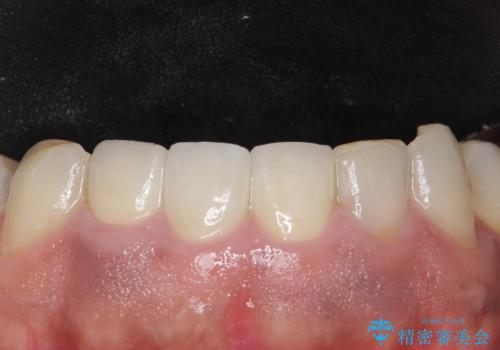 オールセラミッククラウン ブリッジによる欠損歯の補綴の治療後