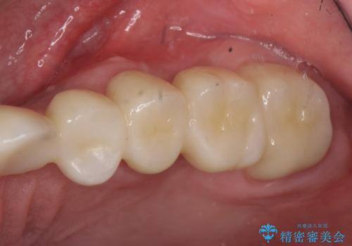 オールセラミッククラウン　ブリッジによる欠損歯の補綴の治療後