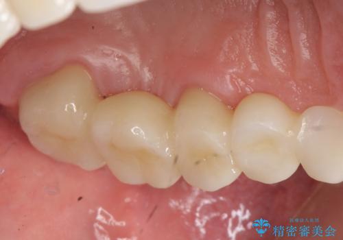 オールセラミッククラウン ブリッジによる欠損歯の補綴の治療後
