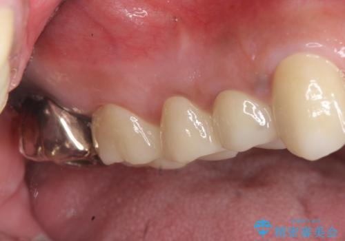 オールセラミッククラウン ブリッジによる欠損歯の補綴の治療後