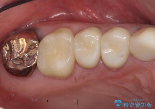 オールセラミッククラウン ブリッジによる欠損歯の補綴の治療後