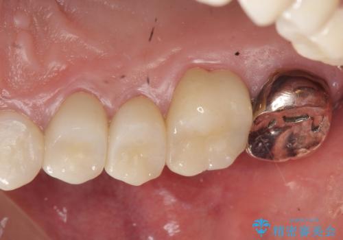 オールセラミッククラウン ブリッジによる欠損歯の補綴の治療後