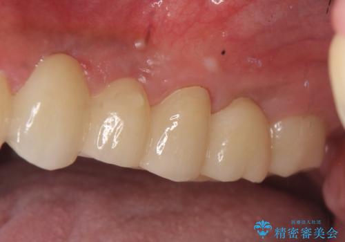 オールセラミッククラウン ブリッジによる欠損歯の補綴の治療後