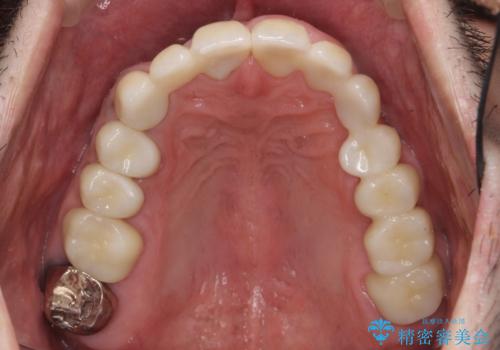 オールセラミッククラウン　ブリッジによる欠損歯の補綴の症例 治療後