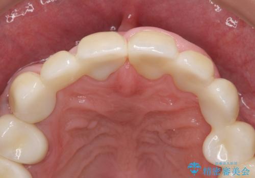 オールセラミッククラウン ブリッジによる欠損歯の補綴の治療後