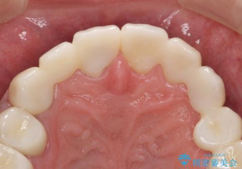 オールセラミッククラウン ブリッジによる欠損歯の補綴の治療後