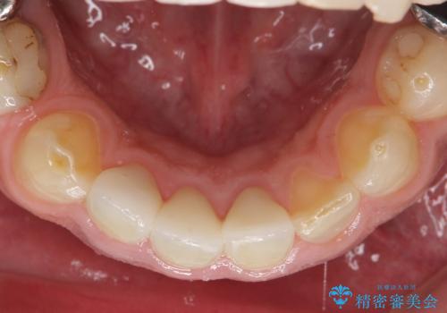 オールセラミッククラウン ブリッジによる欠損歯の補綴の治療後