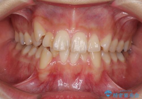 上下の八重歯を治したい　補助装置を用いたインビザライン矯正の症例 治療前