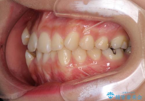 上下の八重歯を治したい　補助装置を用いたインビザライン矯正の治療前
