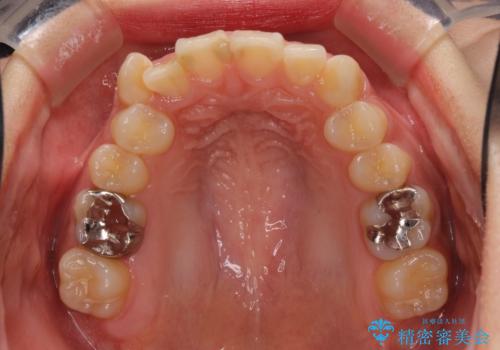 上下の八重歯を治したい 補助装置を用いたインビザライン矯正の治療前