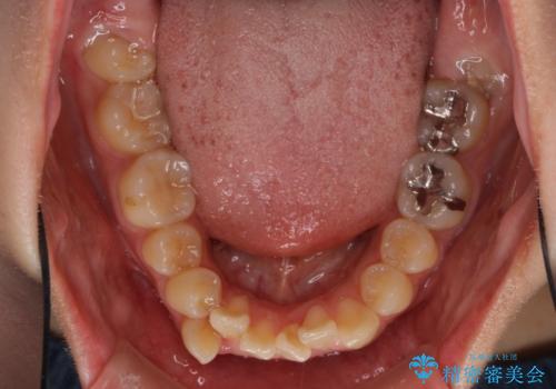 上下の八重歯を治したい 補助装置を用いたインビザライン矯正の治療前