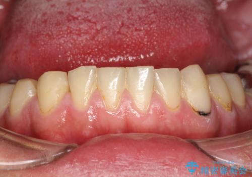 歯医者で口臭予防　PMTCの症例 治療前