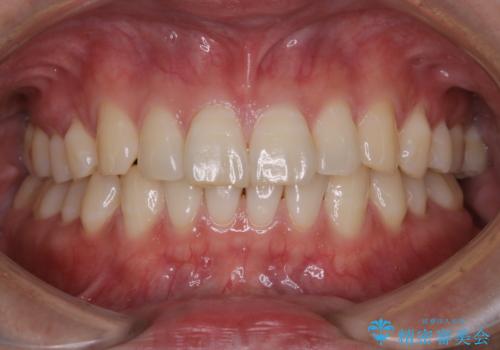 3カ月に1度のPMTCでオーラルケアの治療前