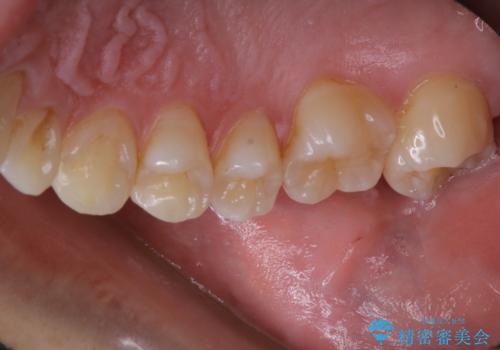 3カ月に1度のPMTCでオーラルケアの治療前