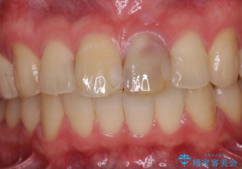 前歯の変色が気になる　オールセラミッククラウンによる審美歯科治療の治療前