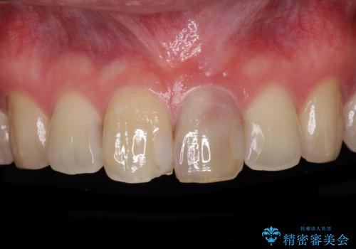 前歯の変色が気になる オールセラミッククラウンによる審美歯科治療の治療前