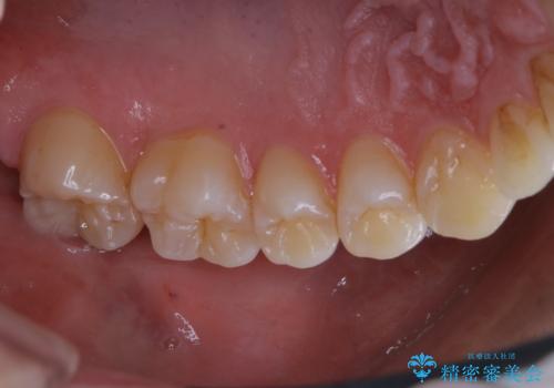 3カ月に1度のPMTCでオーラルケアの治療前