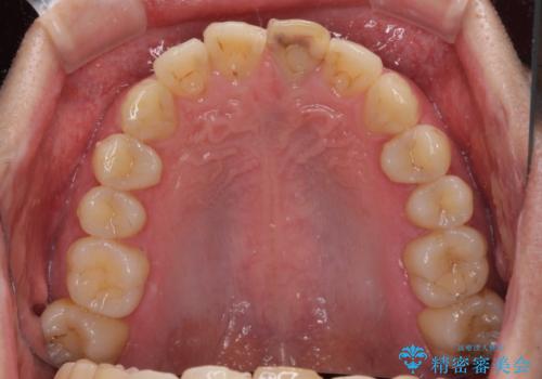 前歯の変色が気になる　オールセラミッククラウンによる審美歯科治療の治療前