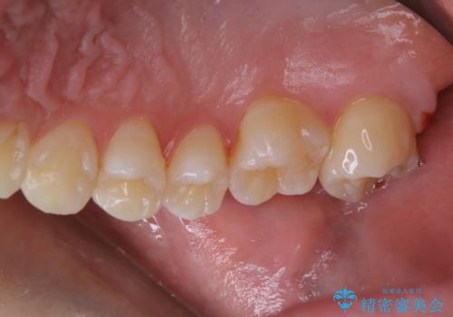 3カ月に1度のPMTCでオーラルケアの治療後