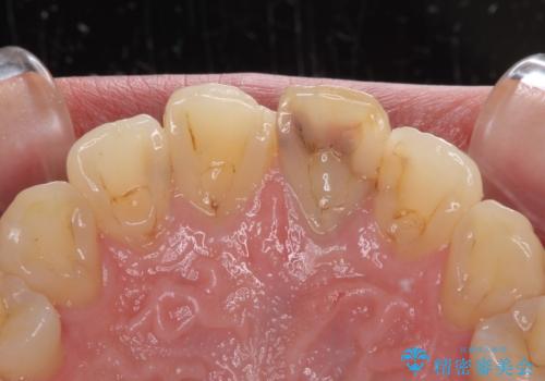 前歯の変色が気になる オールセラミッククラウンによる審美歯科治療の治療前