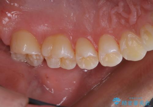3カ月に1度のPMTCでオーラルケアの治療後