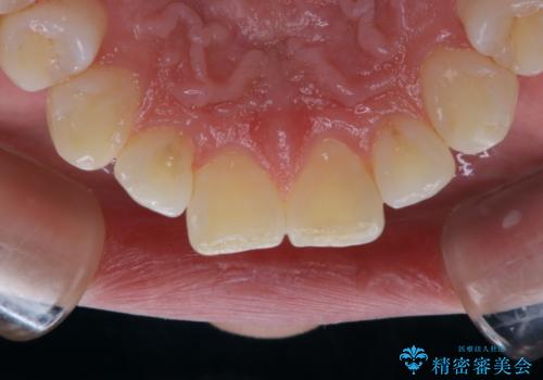 3カ月に1度のPMTCでオーラルケアの症例 治療後