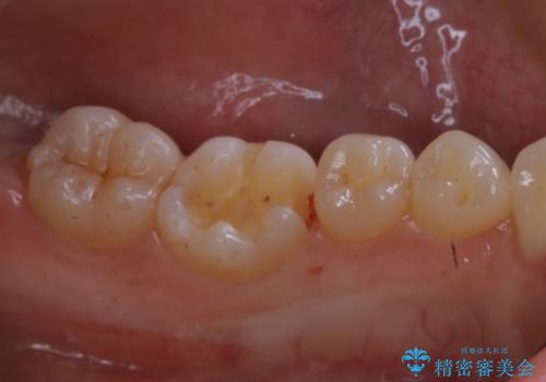 適合のよいセラミックで自分の歯となじむ自然な仕上がりにの治療中