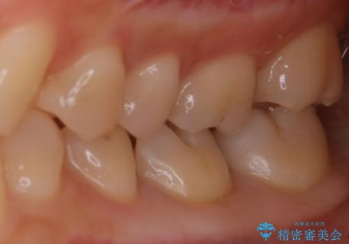 適合のよいセラミックで自分の歯となじむ自然な仕上がりにの治療中