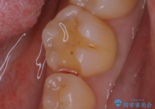 適合のよいセラミックで自分の歯となじむ自然な仕上がりにの治療中