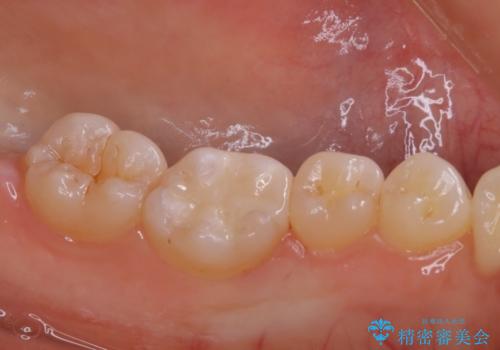 適合のよいセラミックで自分の歯となじむ自然な仕上がりにの治療後