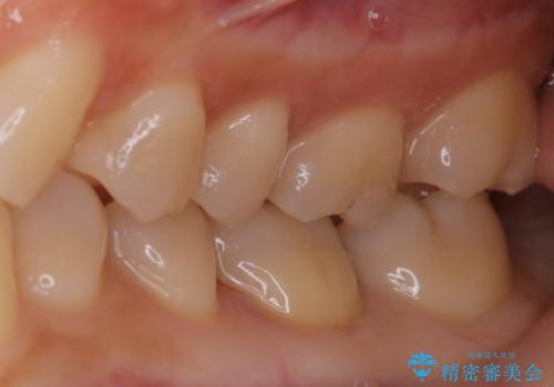 適合のよいセラミックで自分の歯となじむ自然な仕上がりにの治療後