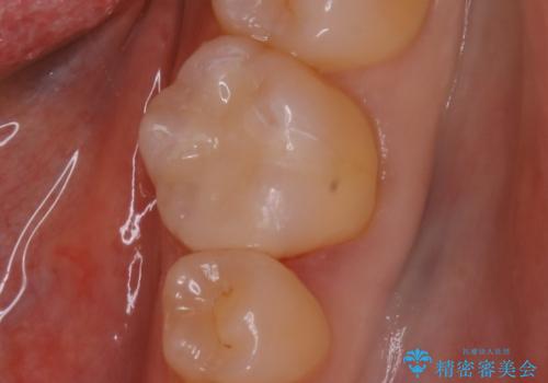 適合のよいセラミックで自分の歯となじむ自然な仕上がりに