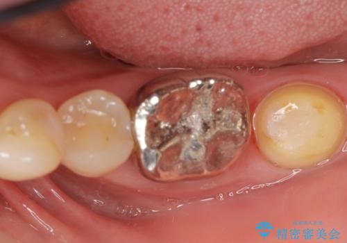 インプラントは嫌 親知らずの移植 50代女性の治療後