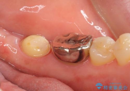 インプラントは嫌 親知らずの移植 50代女性の治療後