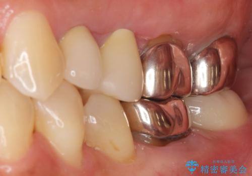 インプラントは嫌 親知らずの移植 50代女性の治療後