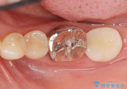 インプラントは嫌 親知らずの移植 50代女性の治療後