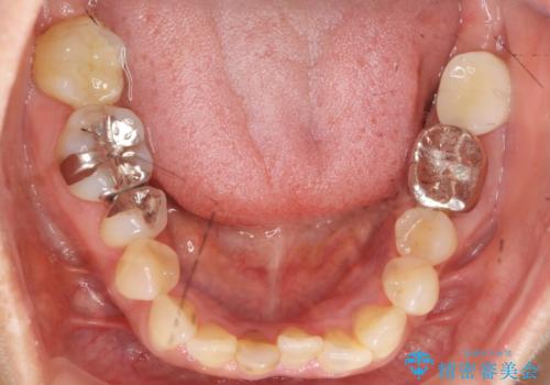 インプラントは嫌 親知らずの移植 50代女性の治療後