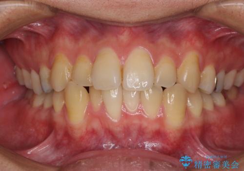 前歯のクロスバイトをインビザラインで矯正治療の症例 治療前