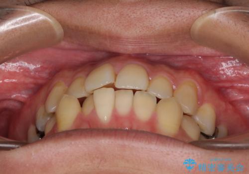 前歯のクロスバイトをインビザラインで矯正治療の治療前