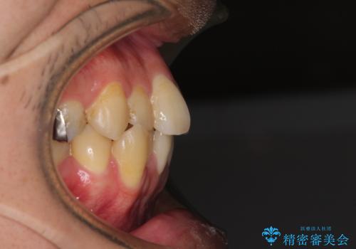 前歯のクロスバイトをインビザラインで矯正治療の治療前