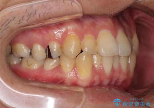 前歯のクロスバイトをインビザラインで矯正治療の治療前