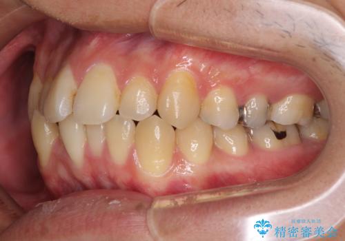 前歯のクロスバイトをインビザラインで矯正治療の治療前