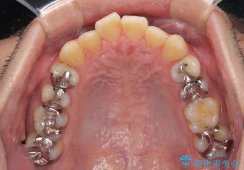 前歯のクロスバイトをインビザラインで矯正治療の治療前