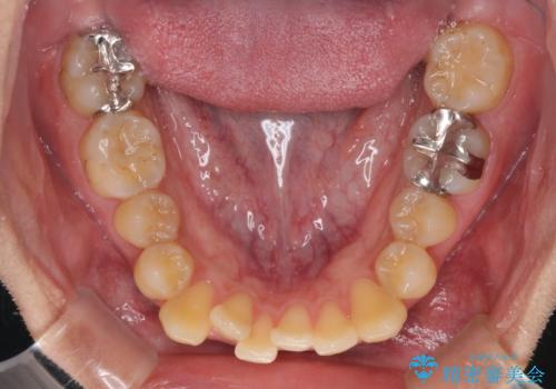 前歯のクロスバイトをインビザラインで矯正治療の治療前