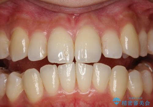 歯の着色・ステイン・ザラつき除去をPMTCでの治療前
