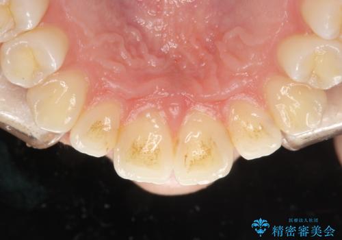 歯の着色・ステイン・ザラつき除去をPMTCでの症例 治療前