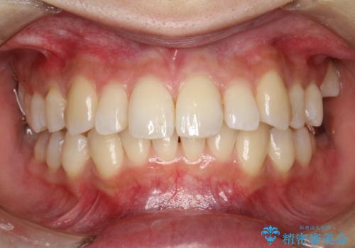 歯の着色・ステイン・ザラつき除去をPMTCでの治療後