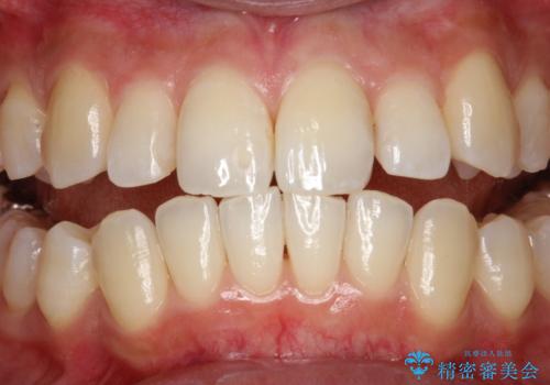歯の着色・ステイン・ザラつき除去をPMTCでの治療後